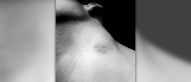 Love bite treatment