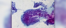 Low thyroid treatment