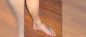 Lower leg cramps