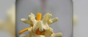Lumbar puncture side effects