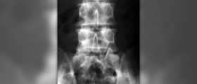 Lumbar spine MRI