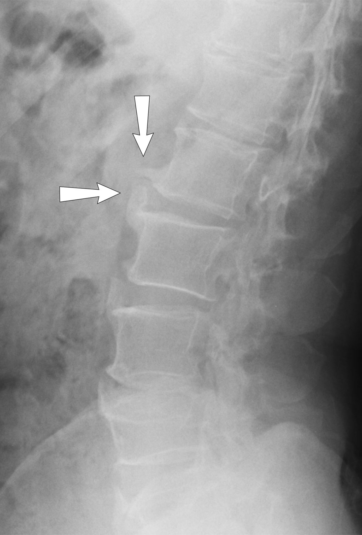 Lumbar spondylosis | General center | SteadyHealth.com