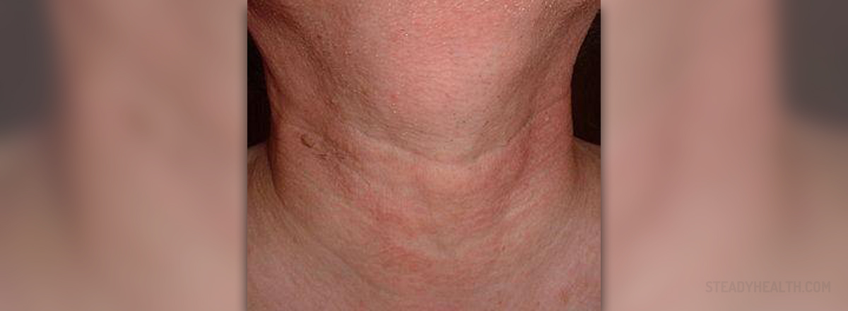 lump-on-back-of-neck-6-possible-causes-you-should-be-aware-of