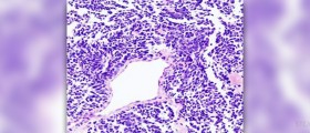 Lung cancer survival rate
