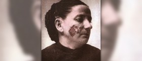 Lupus rash treatment