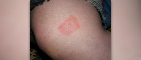 Lyme disease rash