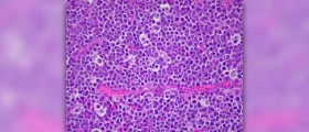 Lymphoma in children review