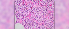 Lymphoma survival rate