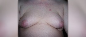Male breasts - gynecomastia