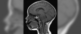 Malignant brain tumor