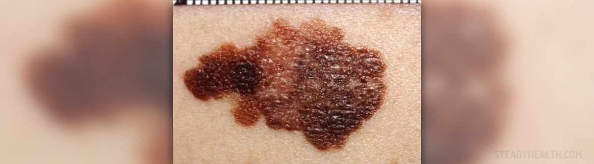 malignant-melanoma-prognosis-general-center-steadyhealth