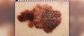 Malignant melanoma prognosis