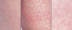 Management of rubella infection in pregnant women