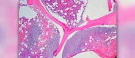 Mantle cell lymphoma