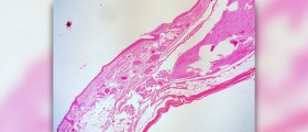 What causes ovarian cyst rupture?