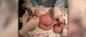 Meconium aspiration and its treatment