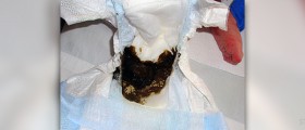 What is meconium?