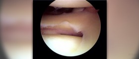Medial meniscus tear