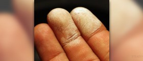 Medical uses of hydrogen peroxide