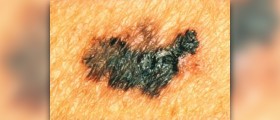 Melanoma prognosis facts
