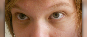 Men's cure for dark circles under the eye