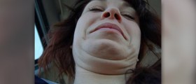 Mentoplasty - the best choice for double chin surgery
