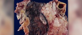 Mesothelioma cancer staging systems explained