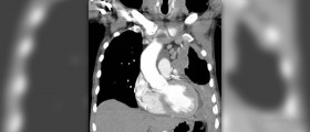 Mesothelioma - is cancer hibernating in you?