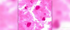 Metastatic breast cancer life expectancy