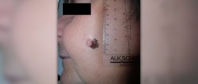 Metastatic melanoma review