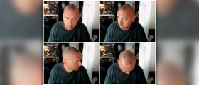 Methods of hair removal