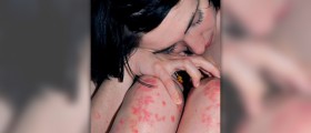 Methotrexate therapy for psoriasis