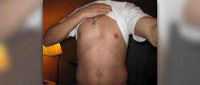 Mild body acne treatments