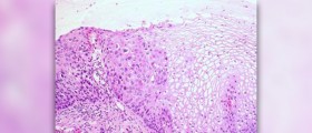 Mild dysplasia facts