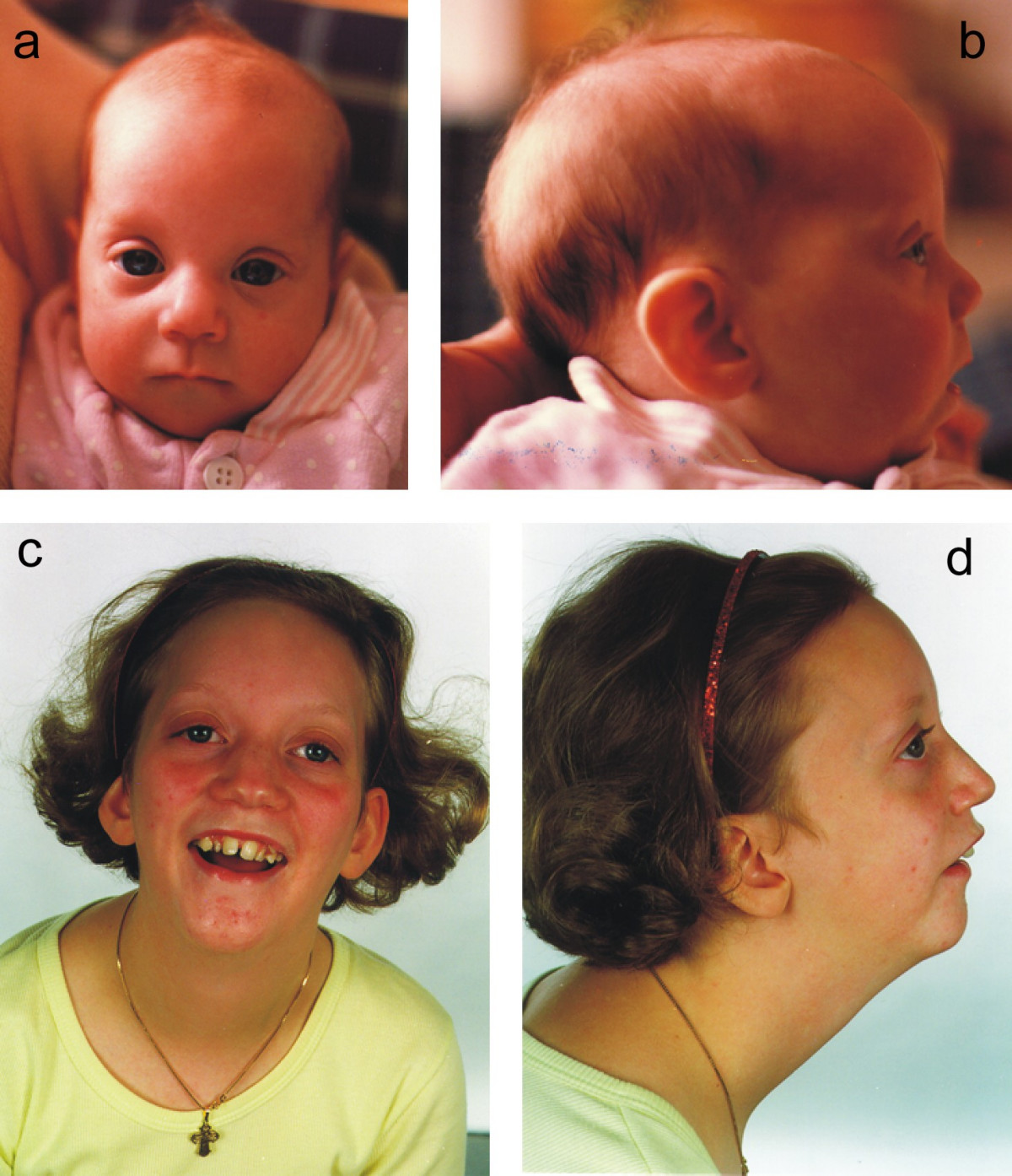 x-linked-severe-mental-retardation-craniofacial-dysmorphology