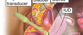 Mirena coil placement procedure