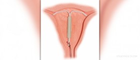 Access to free contraceptives prevents repeat abortions