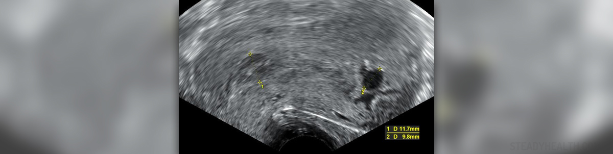 missed-miscarriage-symptoms-general-center-steadyhealth