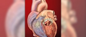 Mitral valve prolapse complications