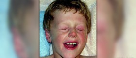 Mold allergy treatment