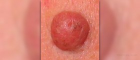 Mole removal at home