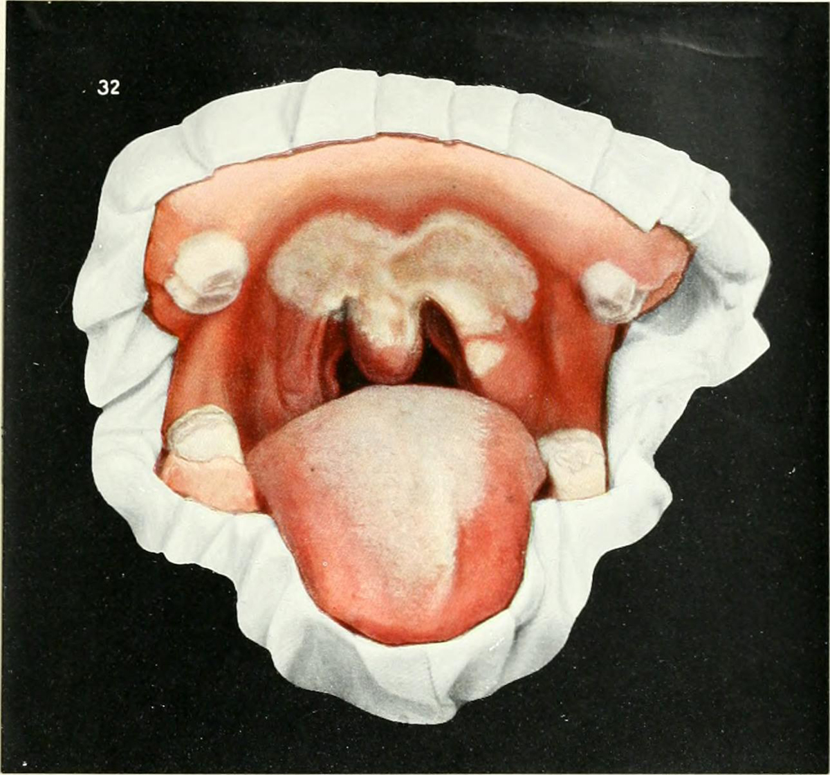 how-to-treat-a-mouth-burn-general-center-steadyhealth