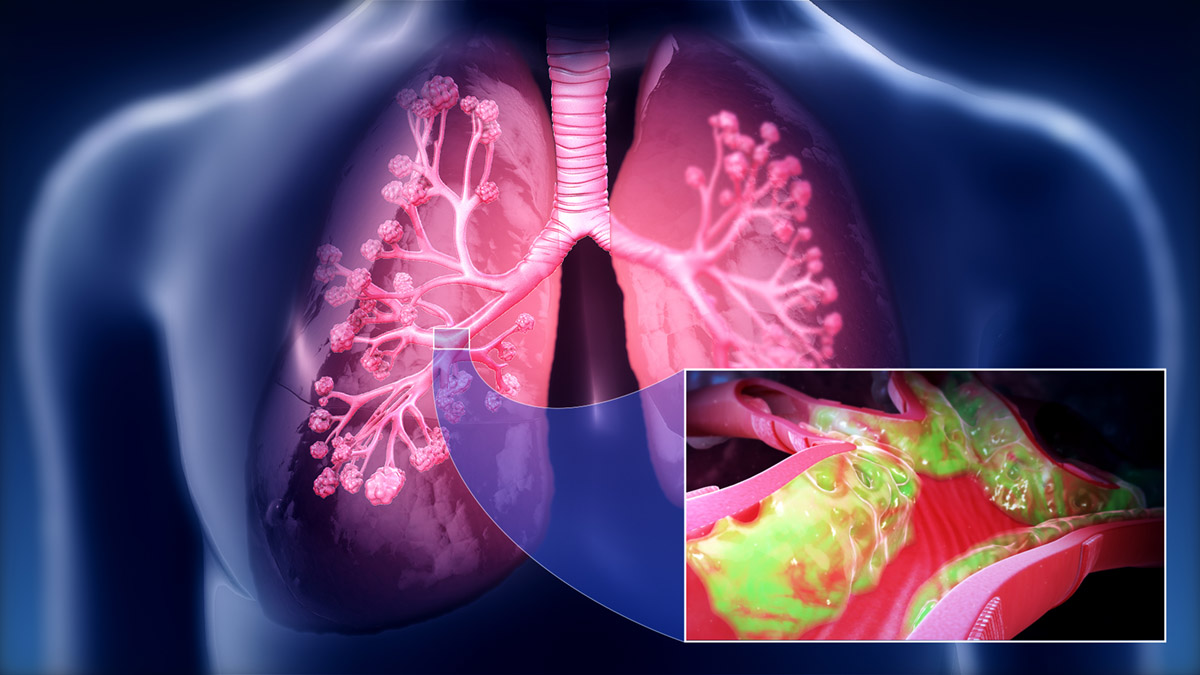 Mucus in lungs | General center | SteadyHealth.com