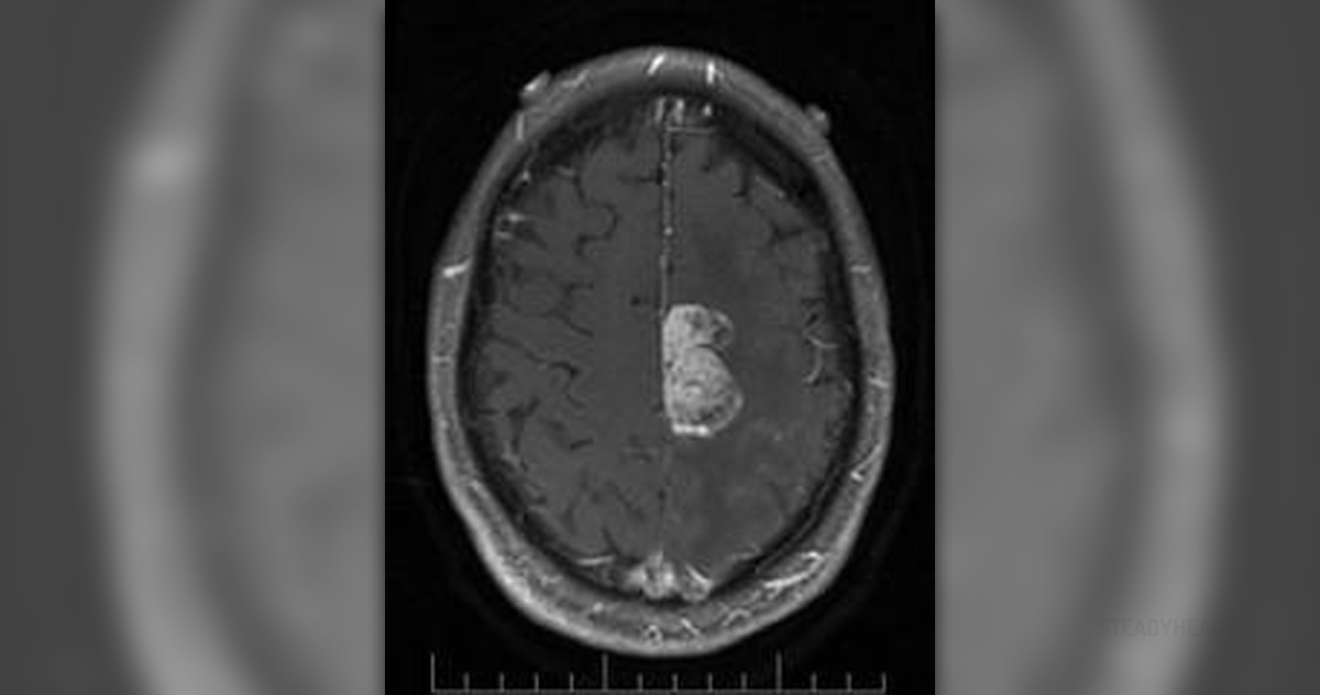 mri sclerosis diagnosing steadyhealth issues