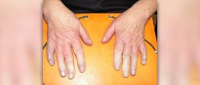 Multiple system atrophy (MSA) - Degenerative neurological disorder
