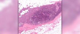 Multivitamins and breast cancer