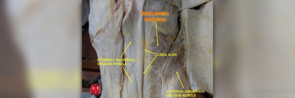 Surgery for separated abdominal muscles