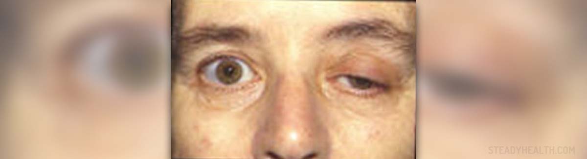 symptoms-and-treatment-for-myasthenia-gravis-general-center