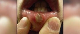 Myths about angular stomatitis