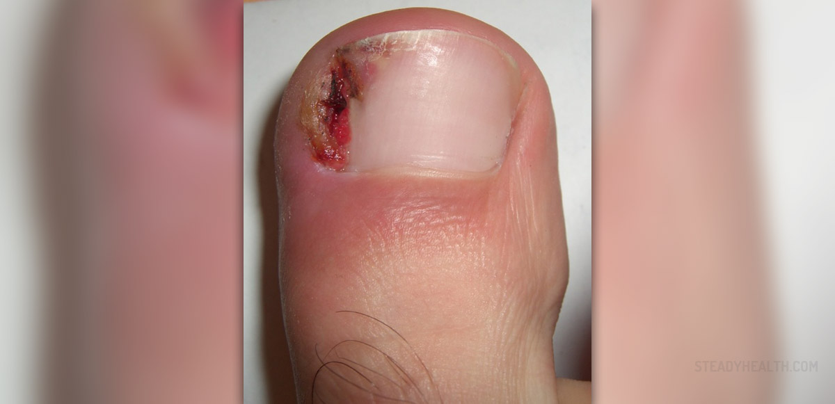 Painful nail bed | General center | SteadyHealth.com